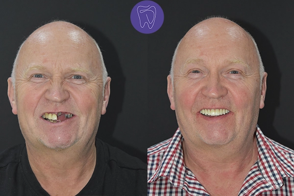 Before After Dental Treatment Antalya Gallery 