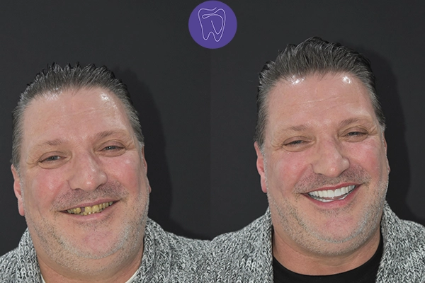 Before After Dental Treatment Antalya Gallery 