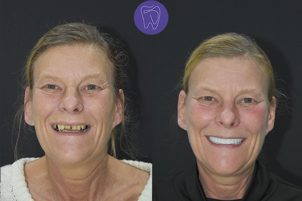 Before After Dental Treatment Antalya Gallery 