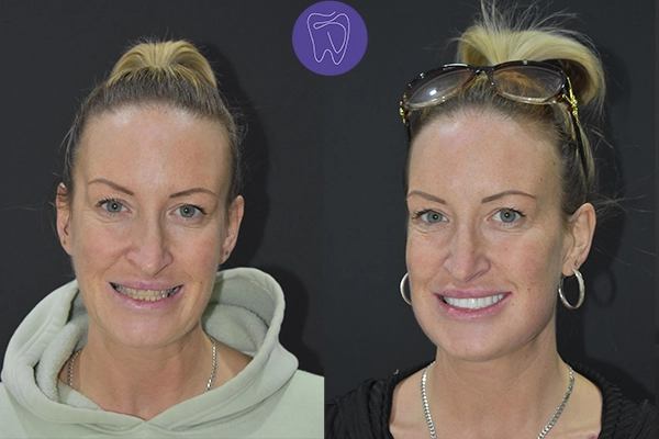 Before After Dental Treatment Antalya Gallery 