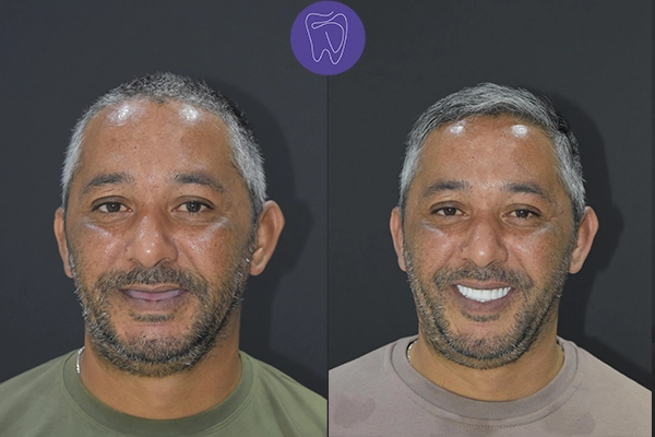 Before After Dental Treatment Antalya Gallery 