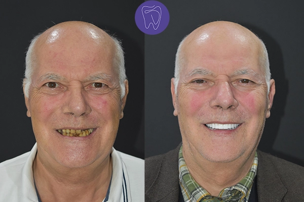 Before After Dental Treatment Antalya Gallery 