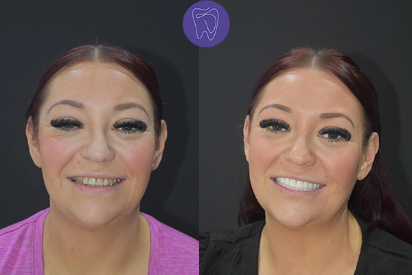 Before After Dental Treatment Antalya Gallery 