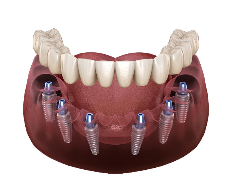 All-on-6 dental implants Antalya Turkey