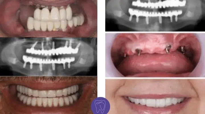 All-on-6 dental implants Antalya Turkey