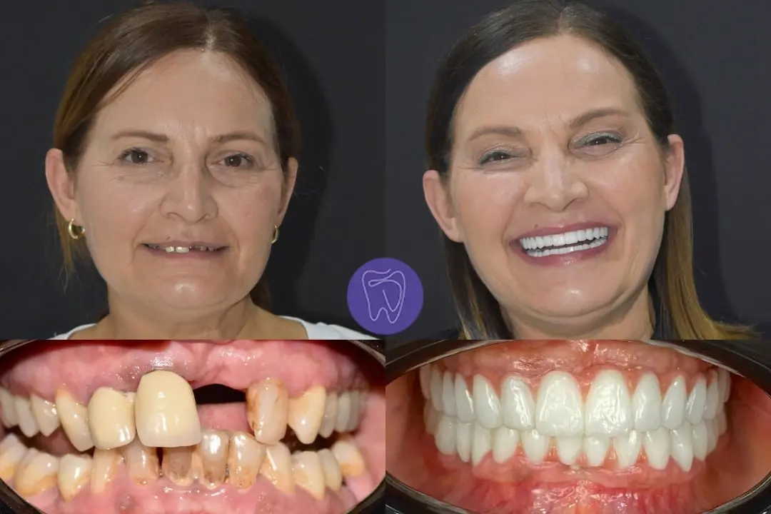All-on-6 dental implants Antalya Turkey
