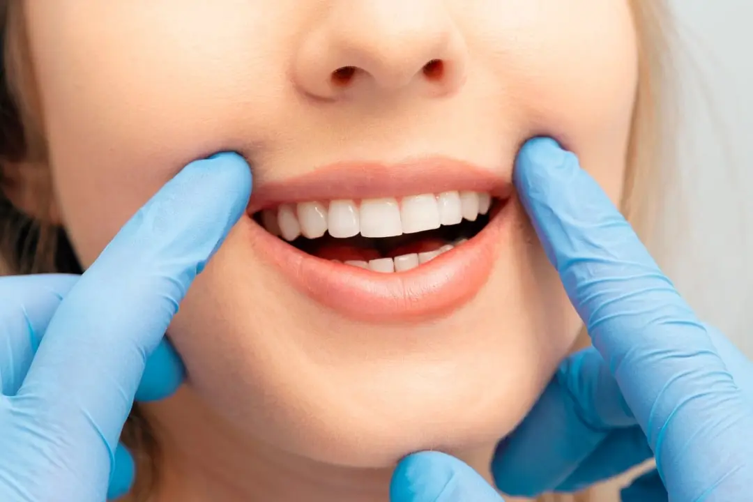 Can you whiten composite bonding?