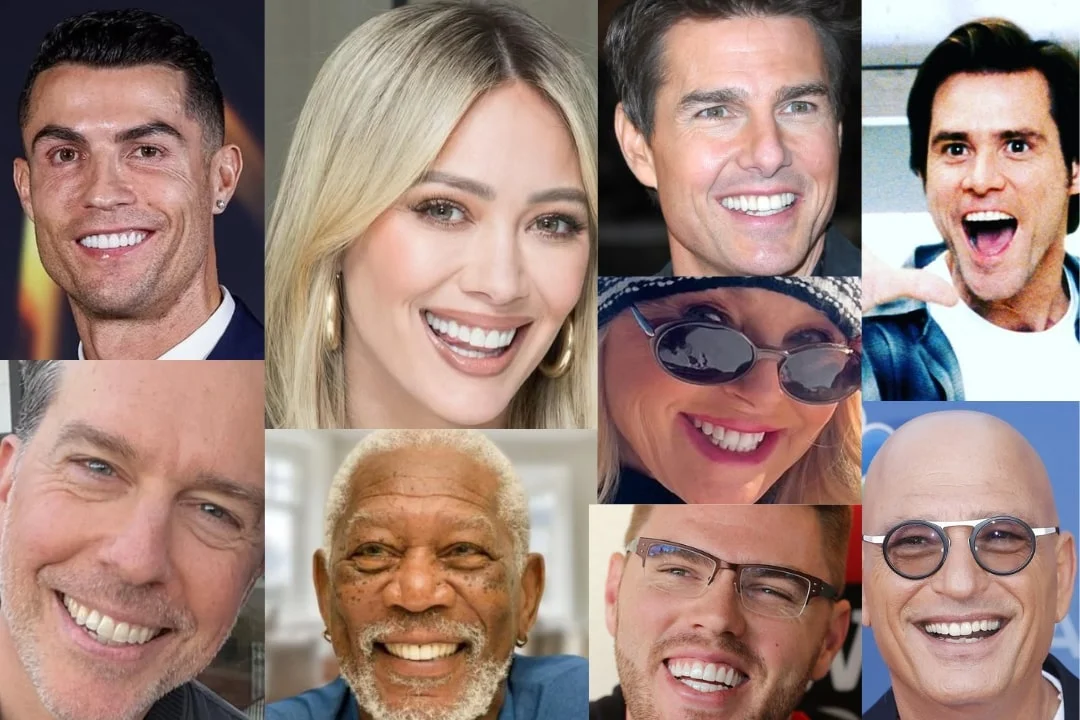 Celebrities with dental implant before after