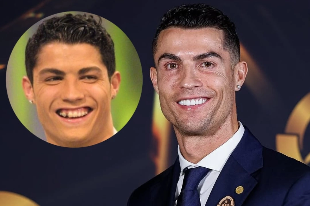 Cristiano Ronaldo teeth implant before after