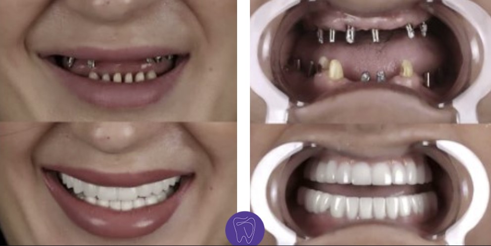 Dental Implant Antalya Turkey