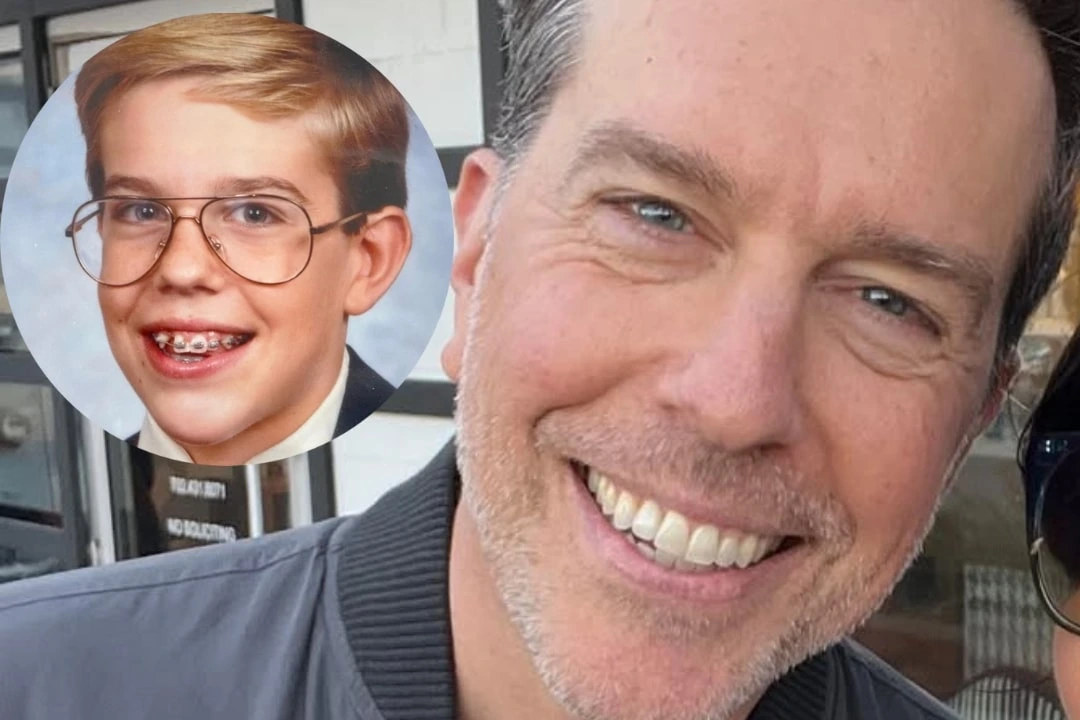 Ed Helms teeth implant before after