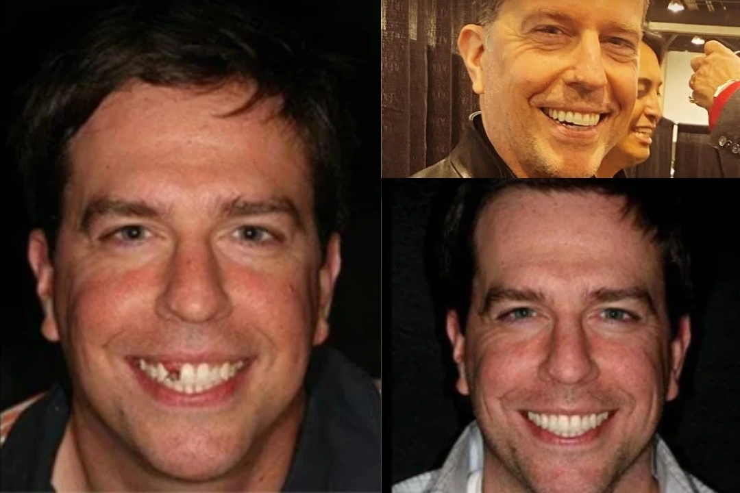 Ed Helms dental implant