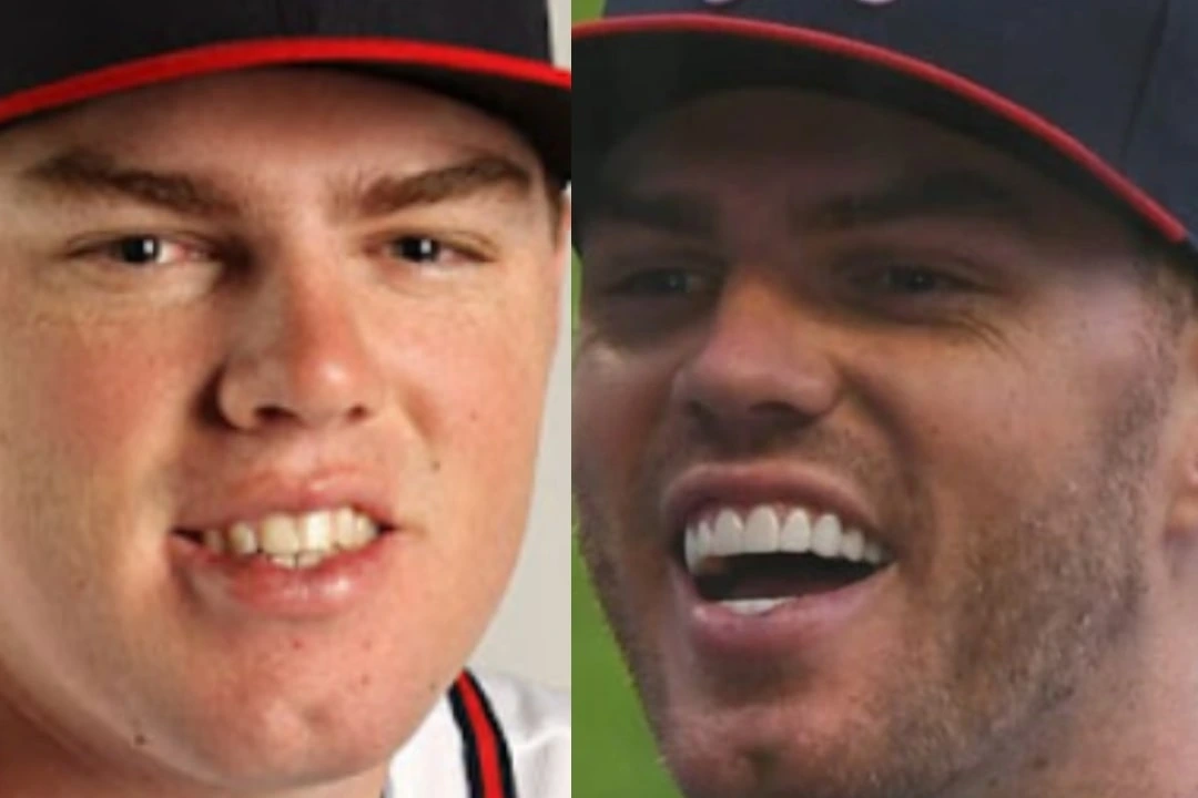 Freddie Freeman teeth implant before after