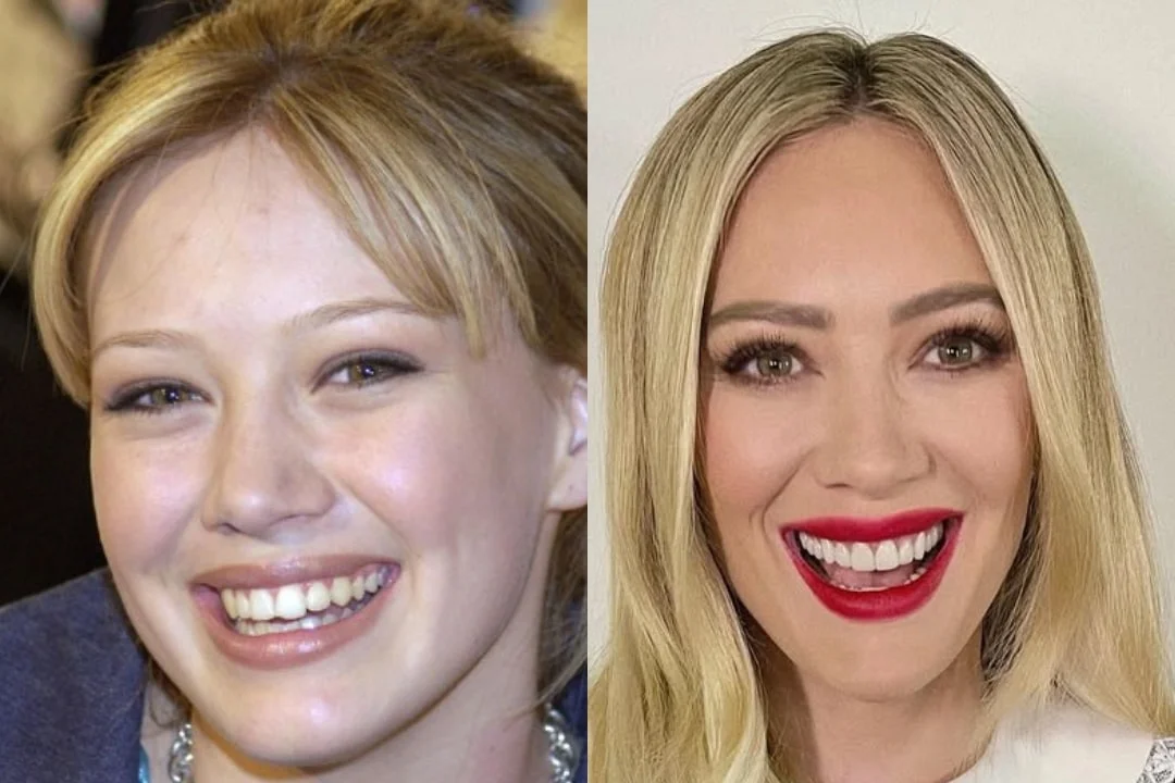 Hilary Duff dental implant before after