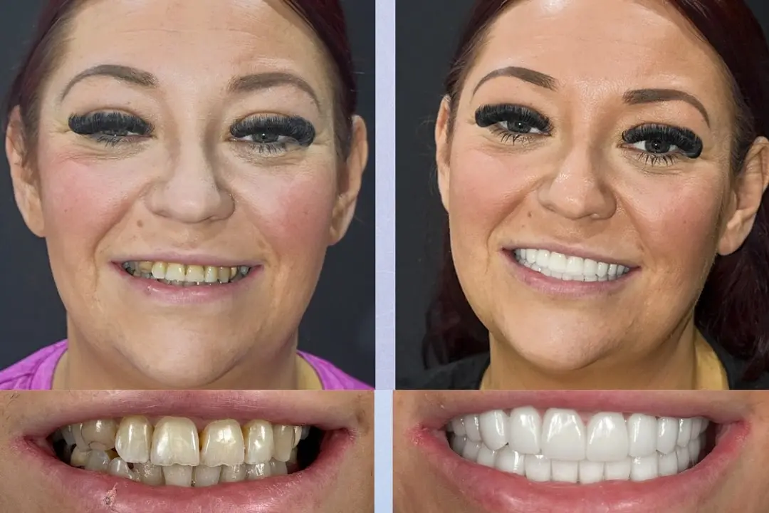 Hollywood Smile procedure in Antalya Turkey
