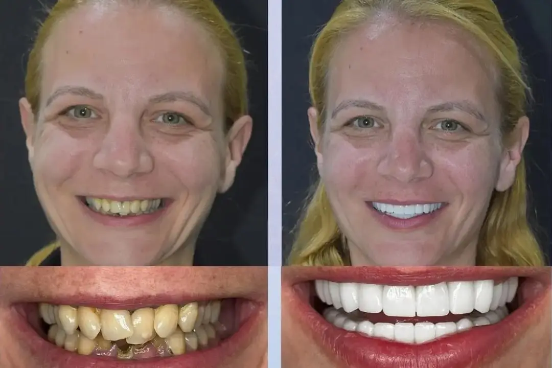  Benefits of Hollywood Smile in Antalya Turkey
