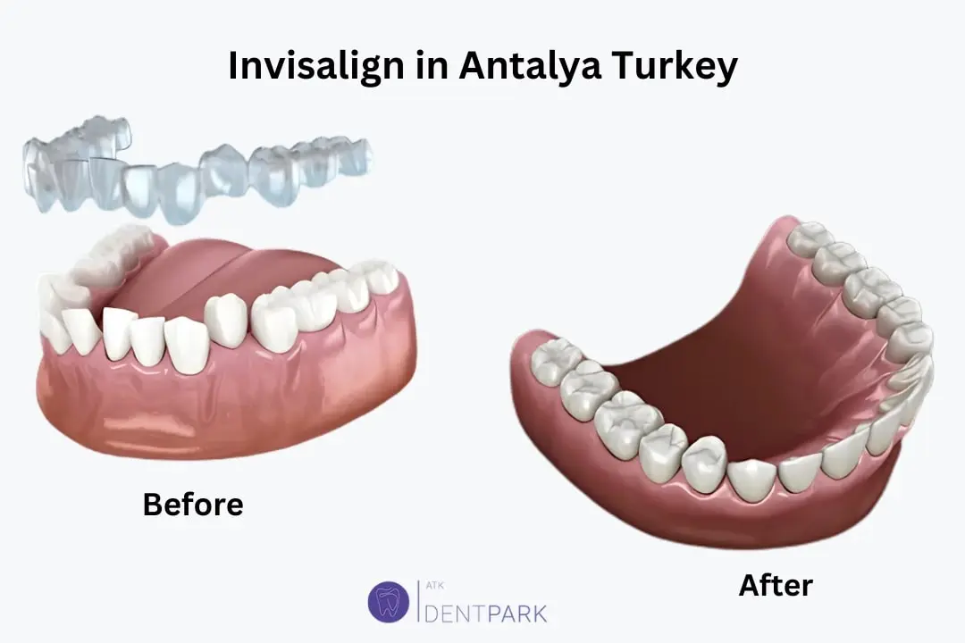 Benefits of invisalign Antalya Turkey