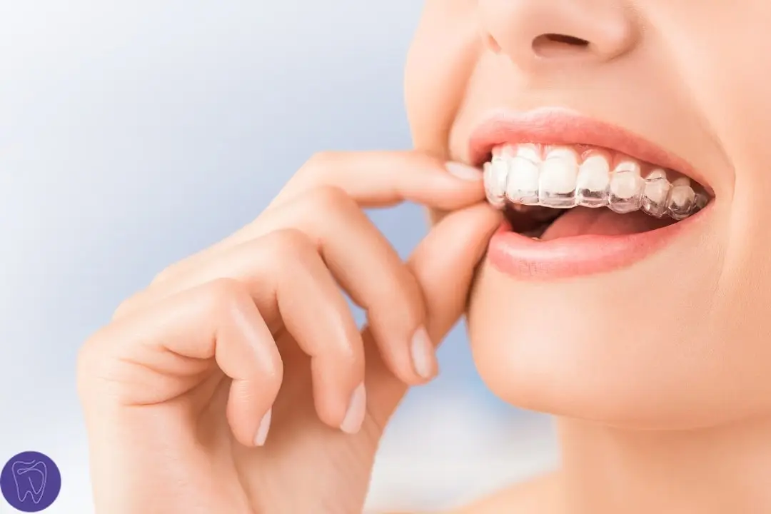 Invisalign, Clear Aligners Antalya Turkey