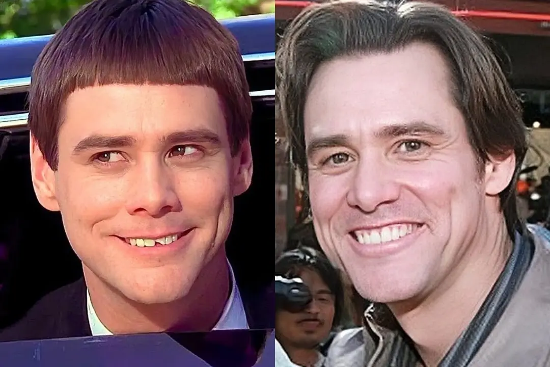 Jim Carrey teeth implant before after