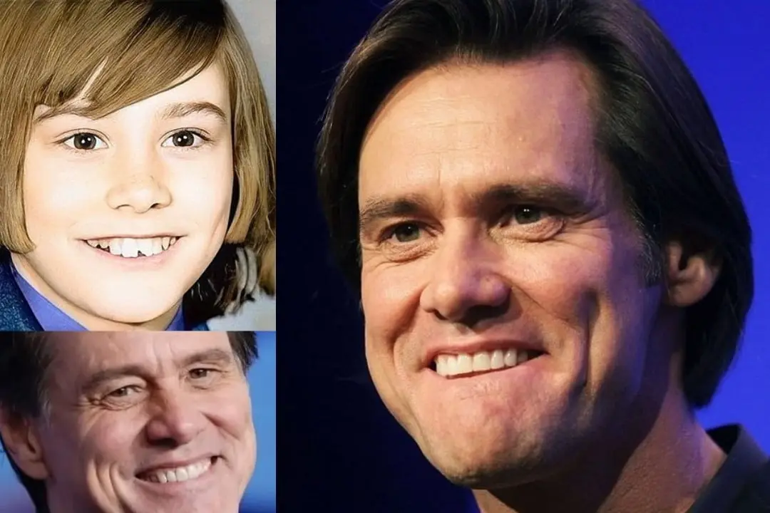Jim Carrey dental implant before after