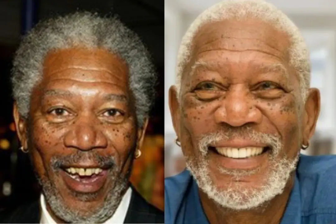 Morgan Freeman dental implant before after
