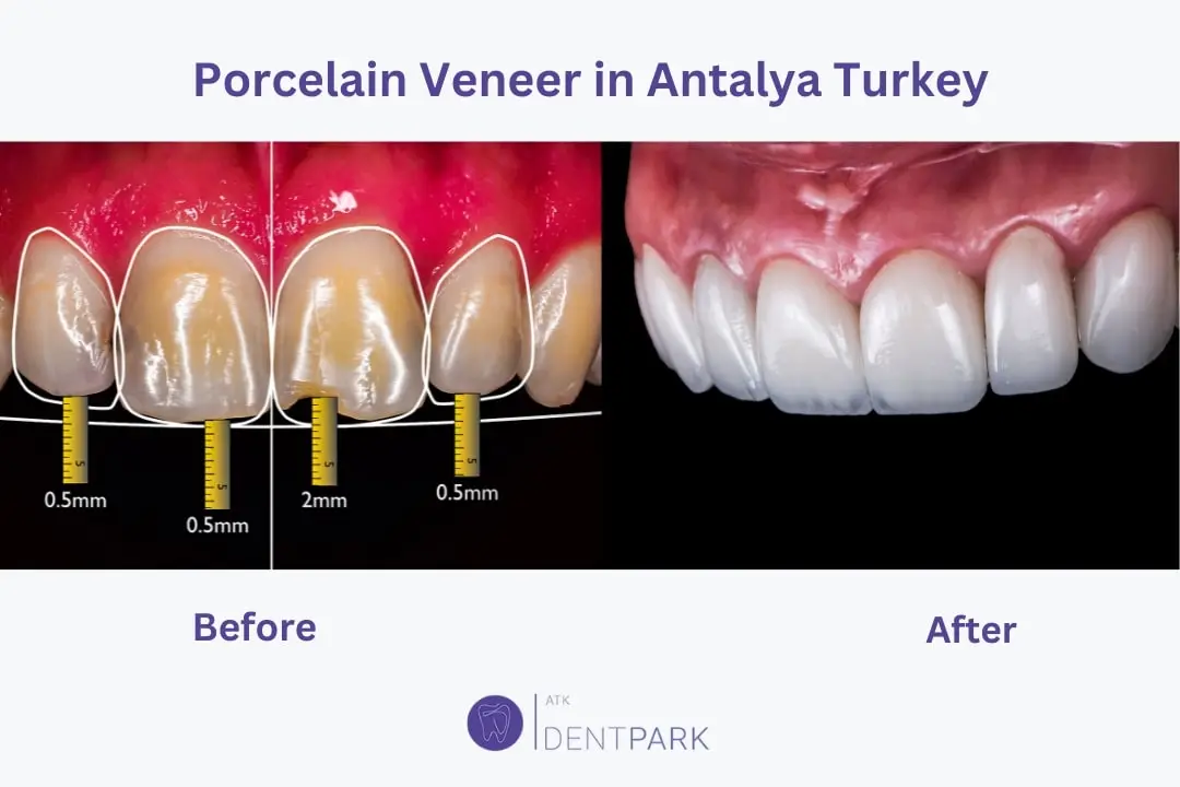Porcelain dental veneers Antalya Turkey