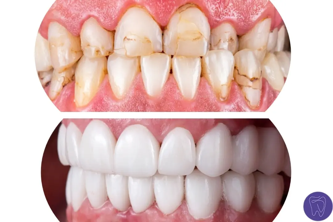 Porcelain Dental Veneers Antalya Turkey