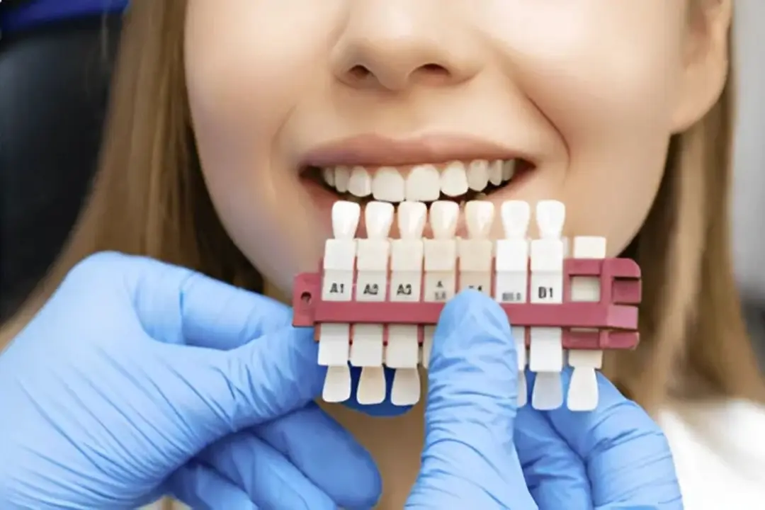 Porcelain Dental Veneers Antalya Turkey