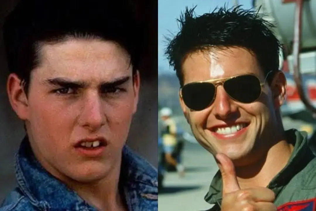 Tom Cruise dental implant before after