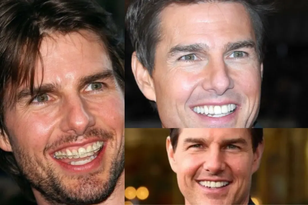 Tom Cruise teeth before after