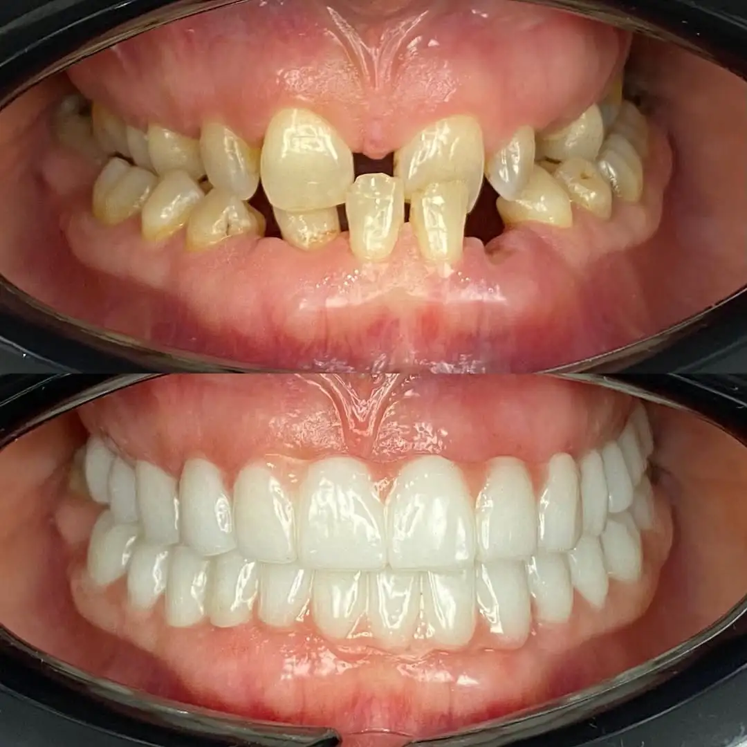 Before After Dental Treatment Antalya